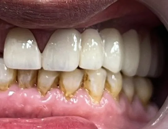 Close-up of teeth after implant treatment, Dr. Md. Miftah Ur Rahman's case