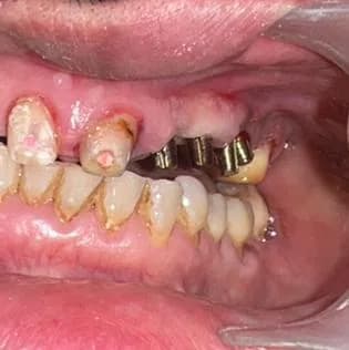 Close-up of teeth before implant treatment, Dr. Md. Miftah Ur Rahman's case