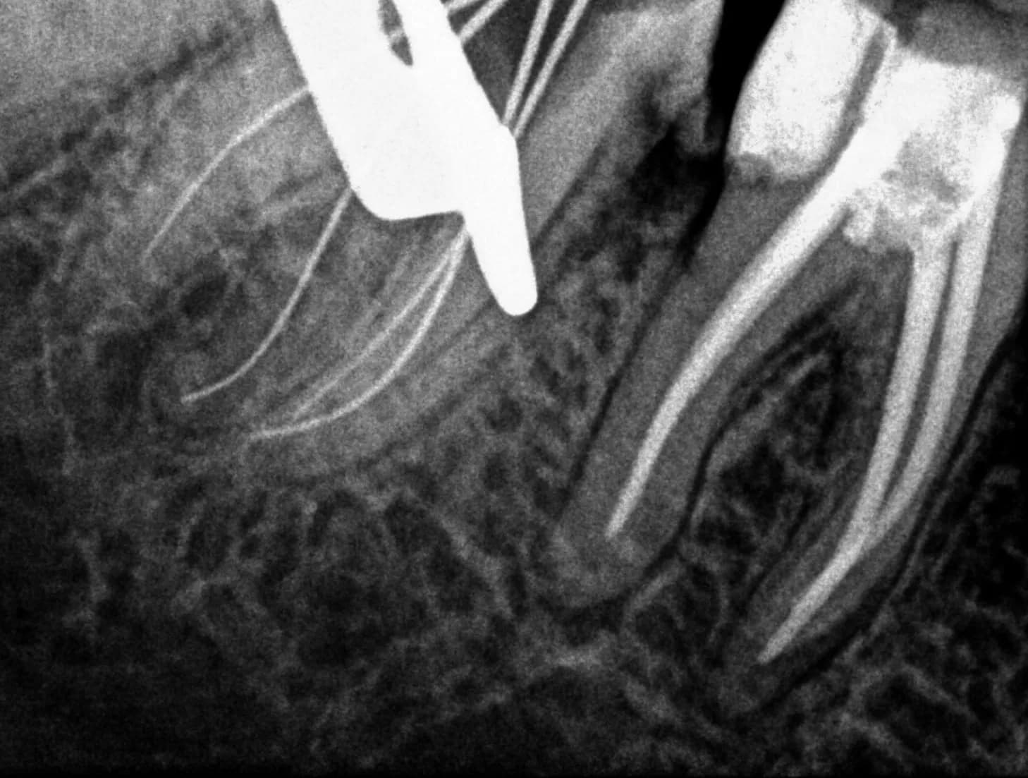 Root canal treatment radiograph — mid-treatment stage