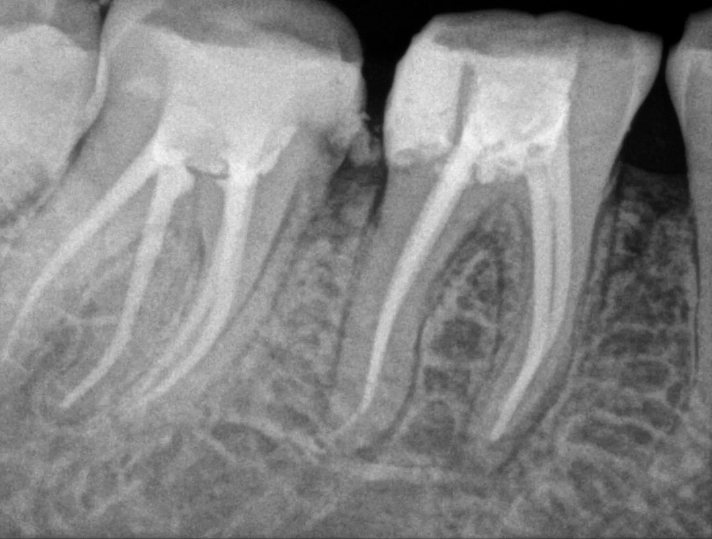 Root canal treatment radiograph — post-treatment stage