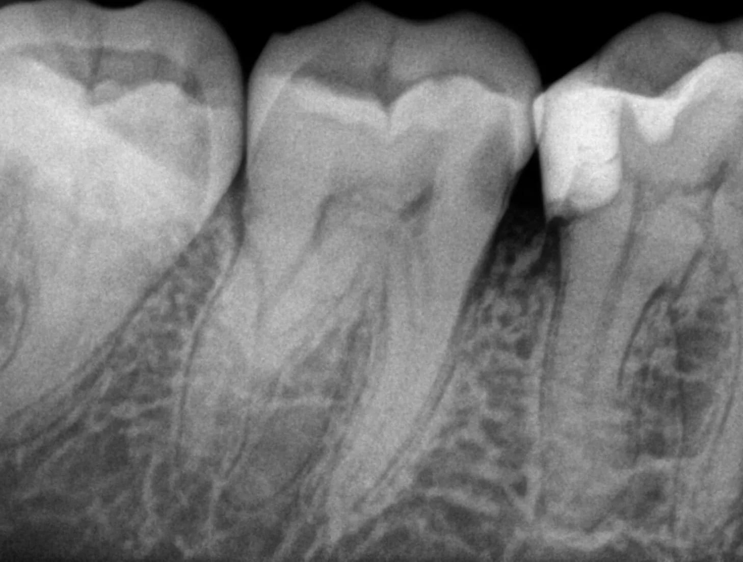 Root canal treatment radiograph — pre-treatment stage