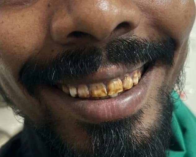 Clinical photograph, step 1 of 6 of one smile design case