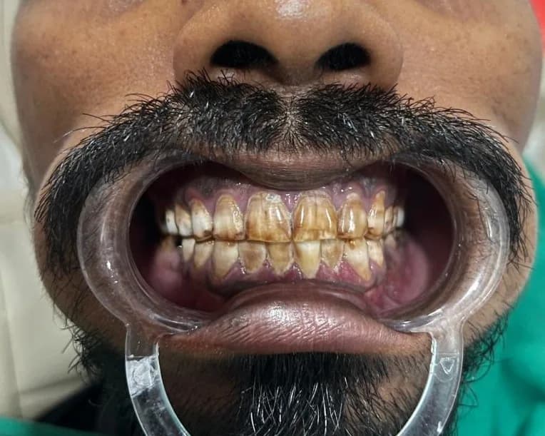 Clinical photograph, step 2 of 6 of one smile design case