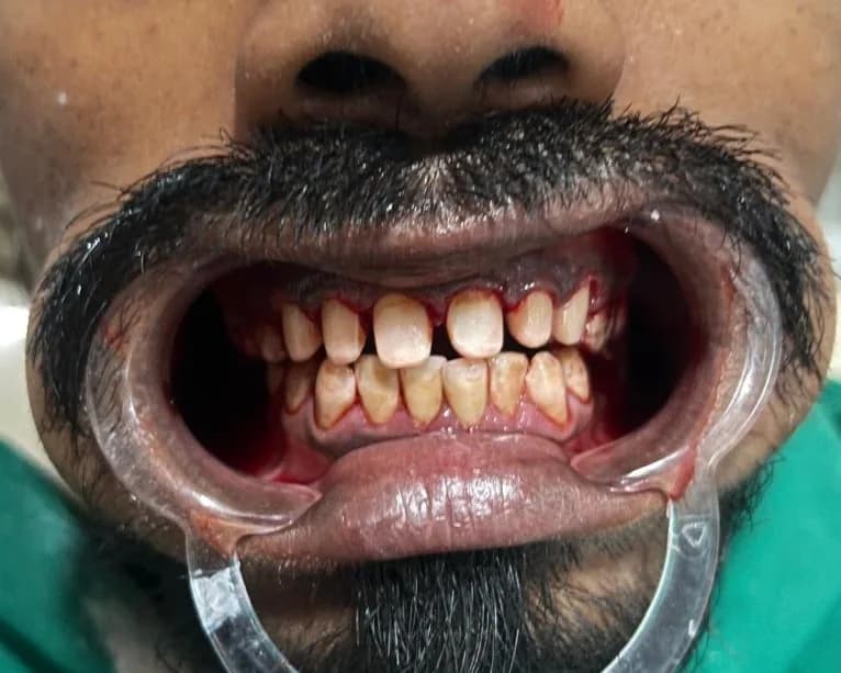 Clinical photograph, step 3 of 6 of one smile design case