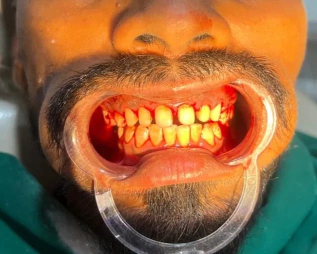 Clinical photograph, step 4 of 6 of one smile design case