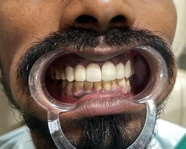 Clinical photograph, step 5 of 6 of one smile design case