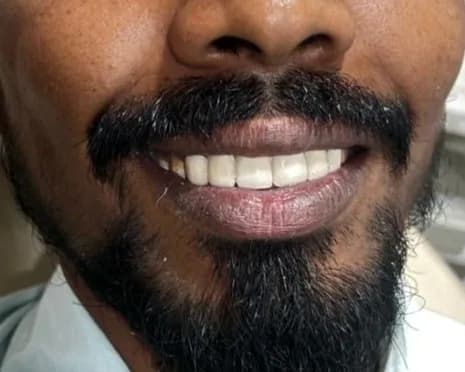 Clinical photograph, step 6 of 6 of one smile design case