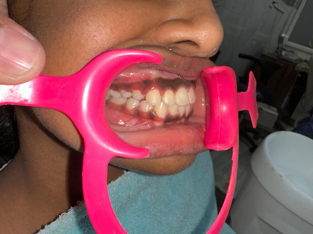 Orthodontics - After Treatment