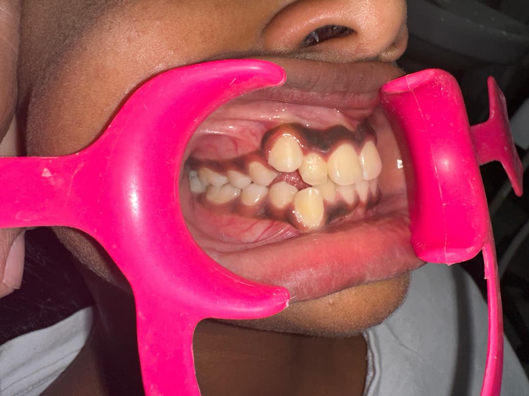 Orthodontics - Before Treatment