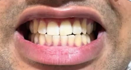 Scaling and polishing treatment at NeoDent - after treatment