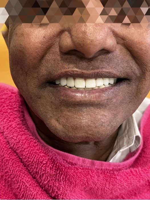 Lower face and teeth after full mouth rehabilitation with dental implants, Mehdipatnam case
