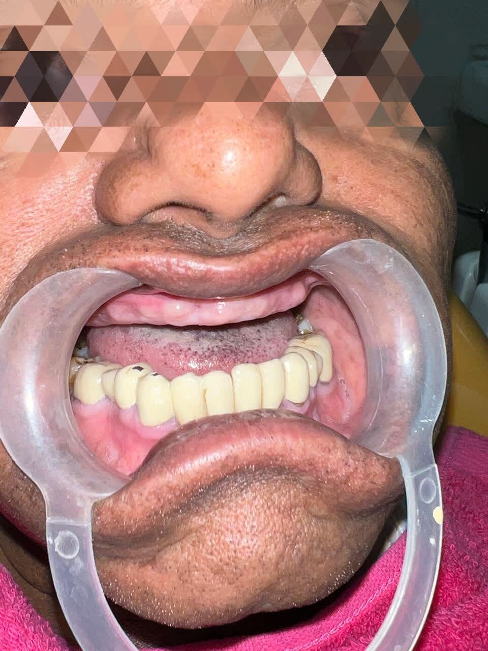 Lower face and teeth before full mouth rehabilitation with dental implants, Mehdipatnam case