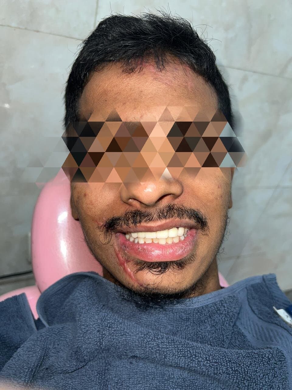 Anterior smile design with zirconia crowns after treatment