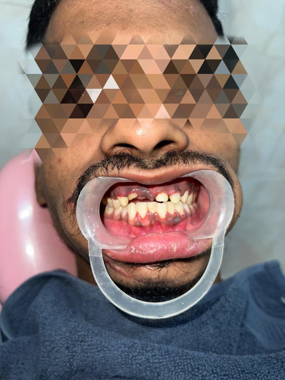 Anterior smile before zirconia crown treatment