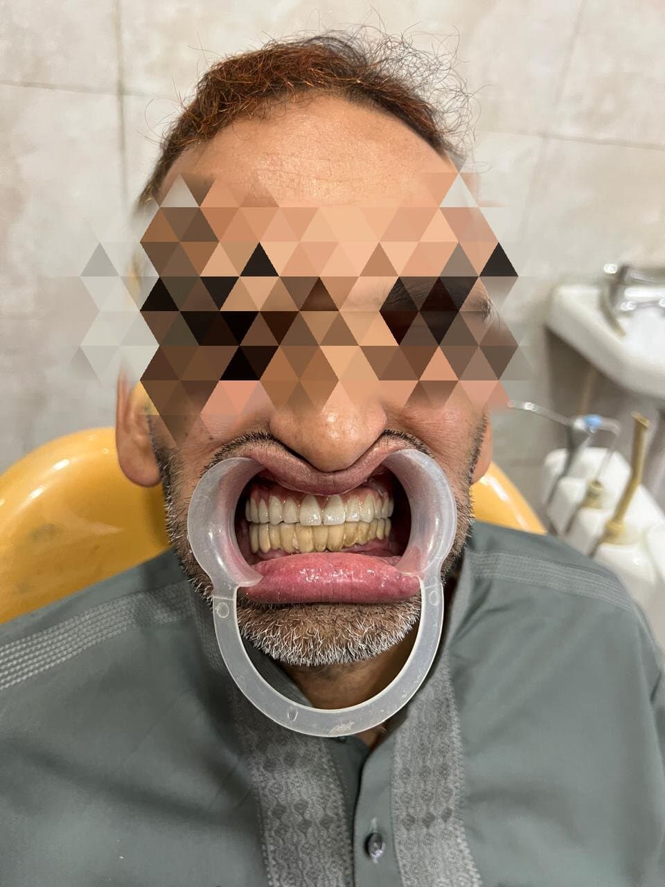 Upper arch rehabilitation with implants after surgery at Neodent Dental Hospital