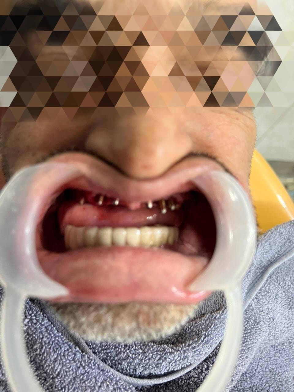 Upper arch before implant surgery, Nampally case