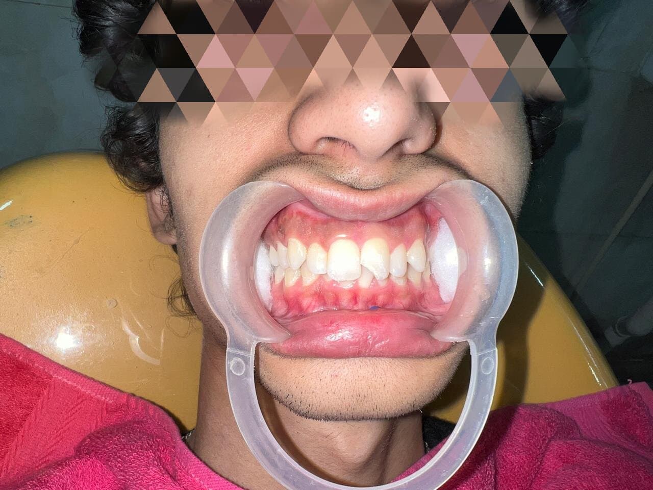 Tooth before composite build-up treatment