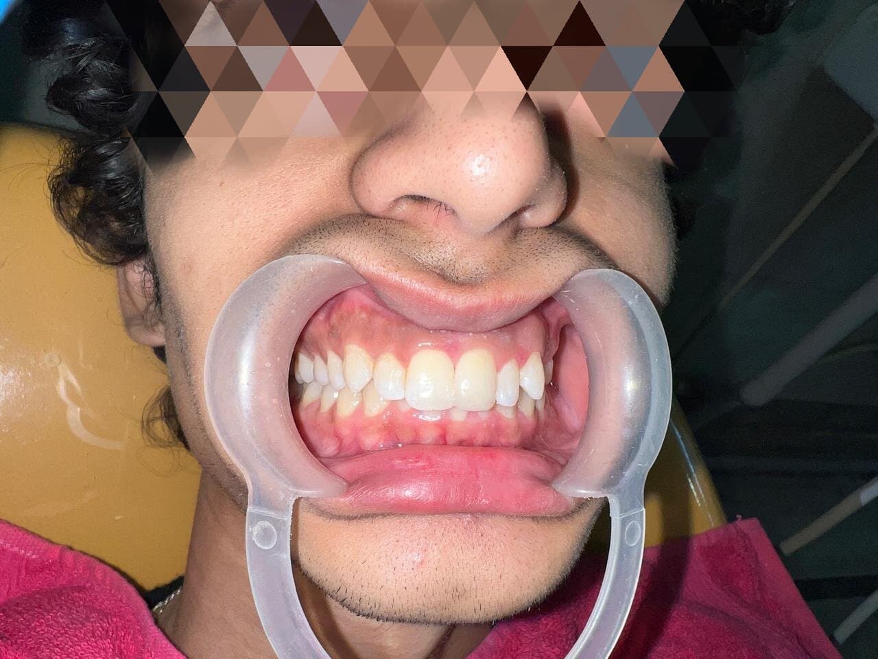 Tooth after composite build-up treatment